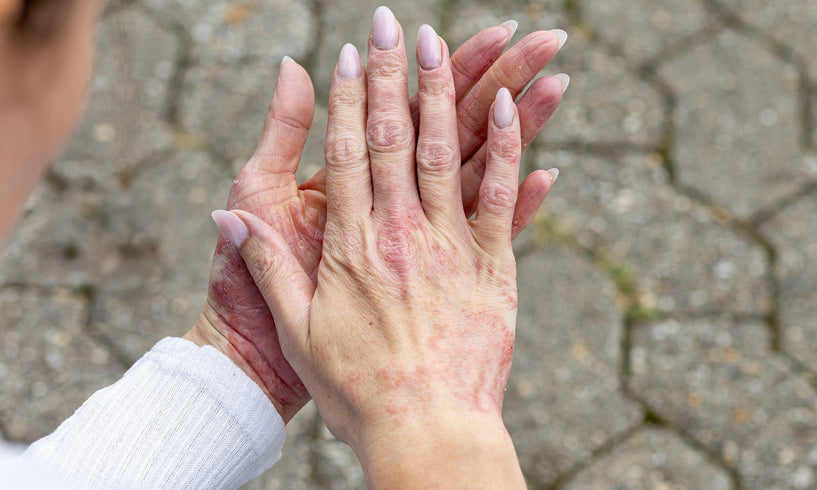 Are stress and eczema connected? image